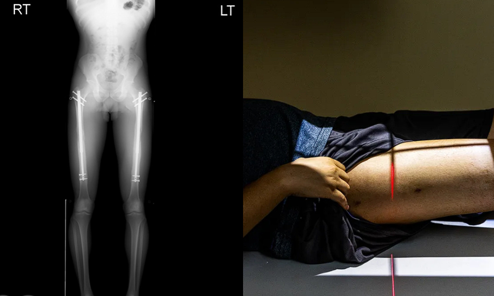 为了变帅变有钱，大厂工程师直接把腿弄断！